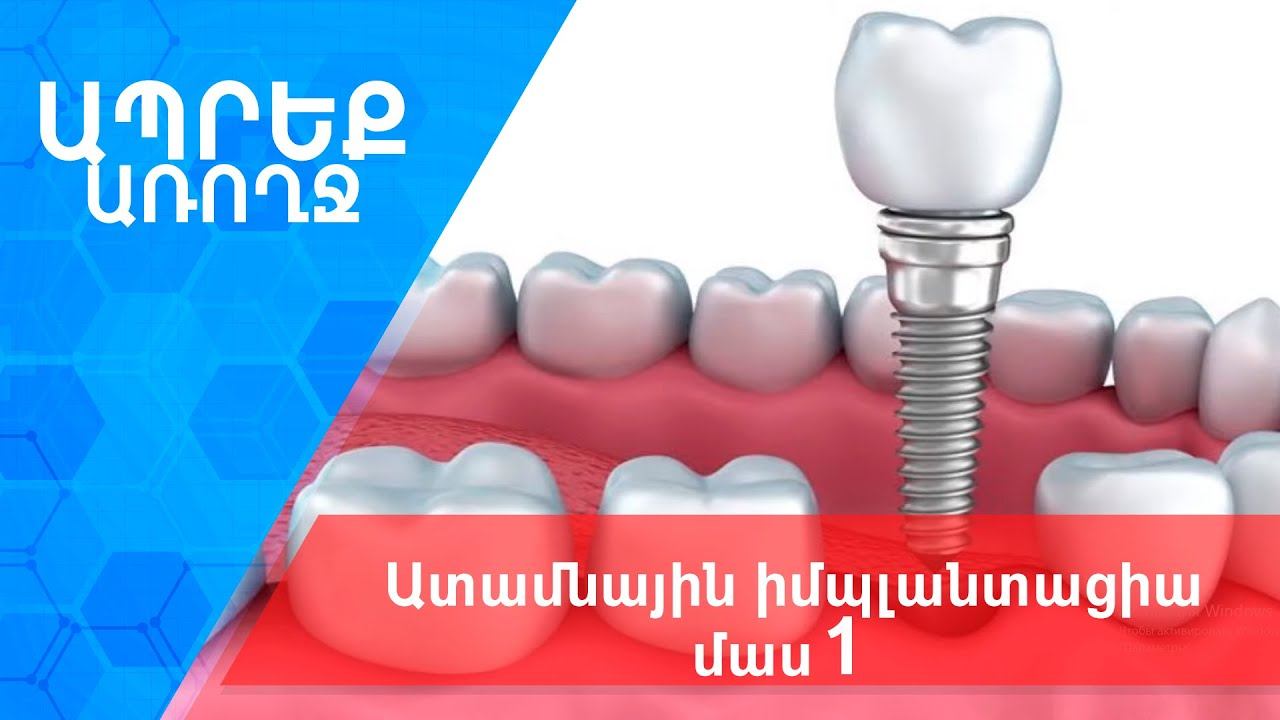 Ապրեք առողջ I Ատամնային իմպլանտացիա, մաս 1 смотреть онлайн