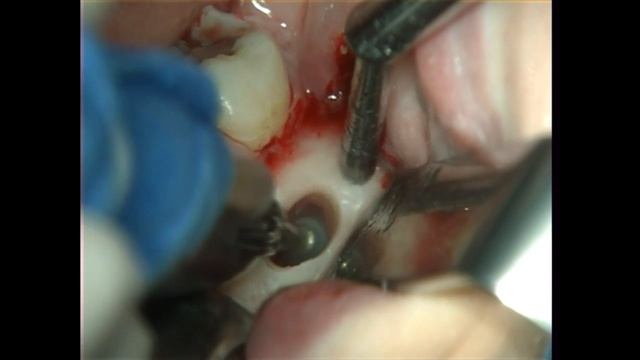 Surgical removal of a simple bone cyst from the posterior mandible смотреть онлайн