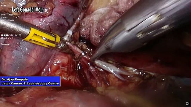 Laparoscopic Left Radical Nephrectomy with Renal Vein thrombosis смотреть онлайн