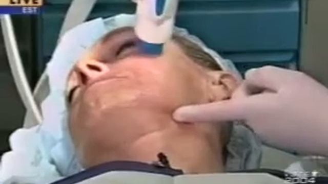 Dr. Michelle Copeland Demonstrates Thermage.