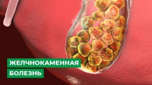 Желчнокаменная болезнь