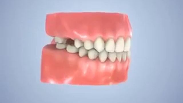 Сьемный протез смотреть онлайн