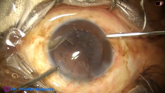 The TRUE GLOW Microscope from Appasamy Associates : Dr Pradip Mohanta, 17th March, 2019 смотреть онлайн