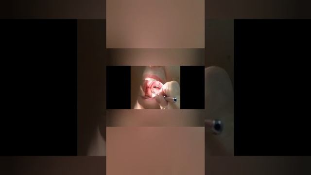 post nasal mirror смотреть онлайн
