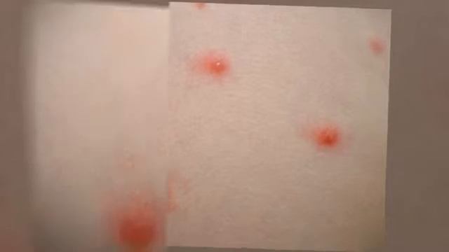 How To Manage Herpes Outreak смотреть онлайн