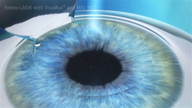 Femto Lasik - Zeiss смотреть онлайн