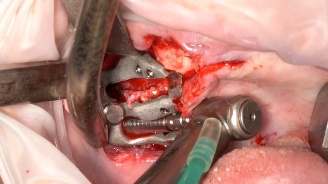 Quadro Zygoma - Full guided protocol смотреть онлайн