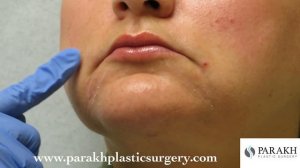 Dr. Parakh - BOTOX Injection to the DAO muscle (Corner of Mouth)