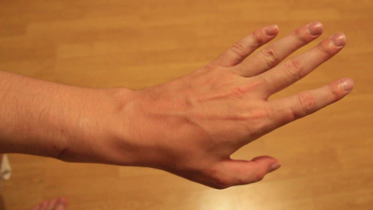 Порез сухожилий запястья 55 дней после операции смотреть онлайн