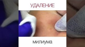 Удаление милиума