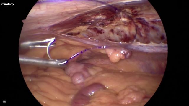 TAPP пластика пупочной грыжи