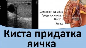 Киста придатка яичка