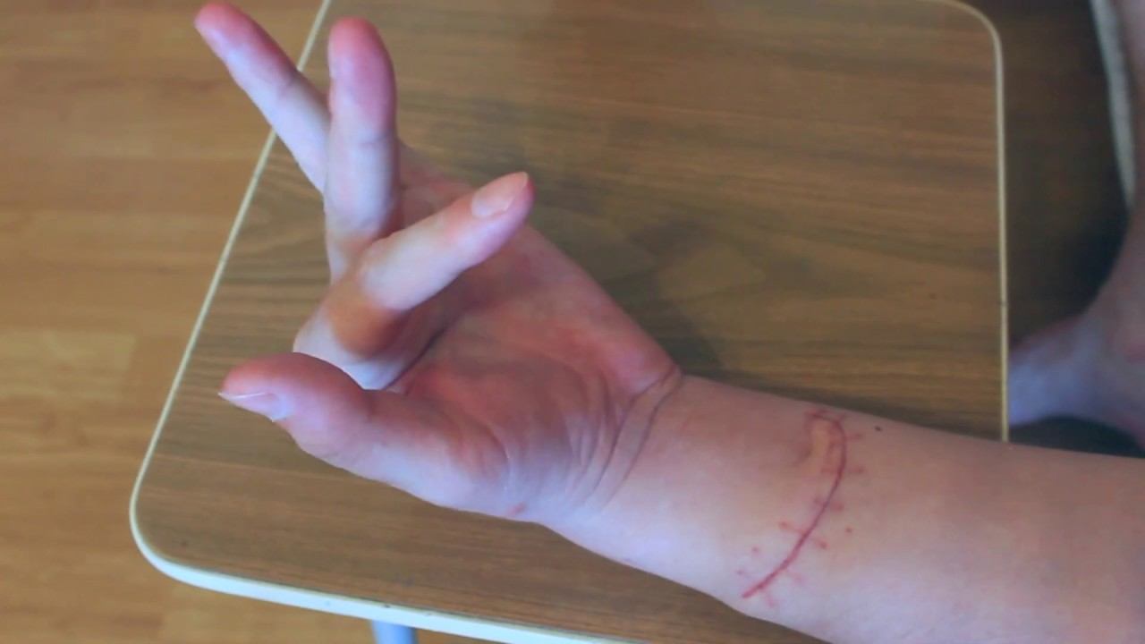 порез сухожилий предплечья. 28 дней после травмы смотреть онлайн