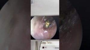 Удаление серная пробка