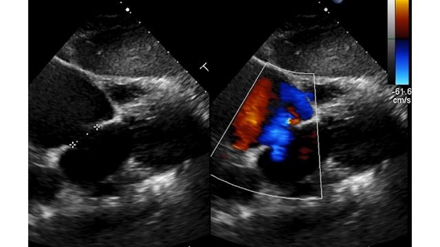 ASD with right to left shunt on colour Doppler echocardiography смотреть онлайн