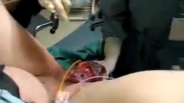 Видео роды с помощью акушерских щипцов  Посмотреть видео роды с помощью акушерских щипцов