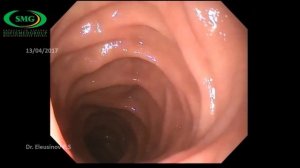 Эндоскопическое удаление инородного тела из  дивертикула двенадцатиперстной кишки