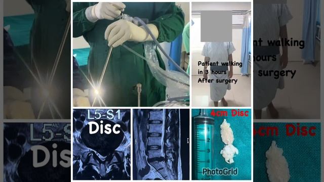SPINE ENDOSCOPY 5 (STICTH LESS SPINE SURGERY) #spineadjustment #hyderabad #neuro #backpain #sciatic