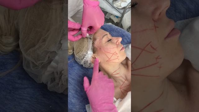 Полимолочная кислота Аэстефил