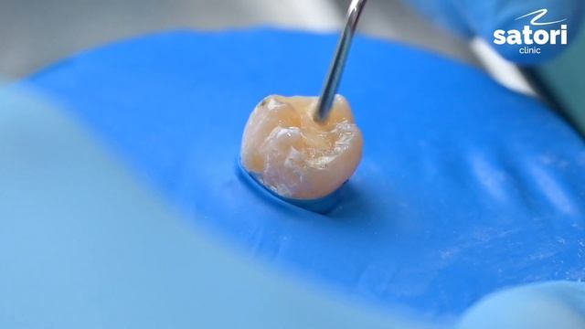 Процесс лечения кариеса #стоматология #кариес #лечениезубов