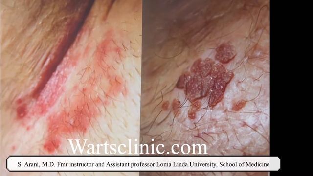 Groin warts spread by acid topical , imiquimod cream in 2 months смотреть онлайн