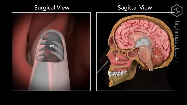 Nasal Polyp Removal смотреть онлайн