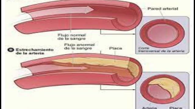 las personas con insuficiencia renal tienen más riesgo de tener un infarto ¡ Averigua el por qué! смотреть онлайн