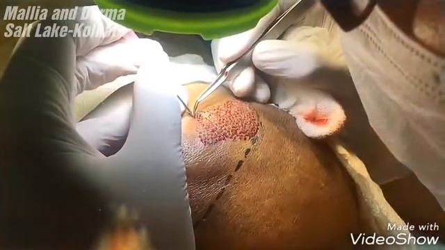 Hair Transplantation Surgery in Kolkata - Mallia & Derma - 12-05-2018 смотреть онлайн