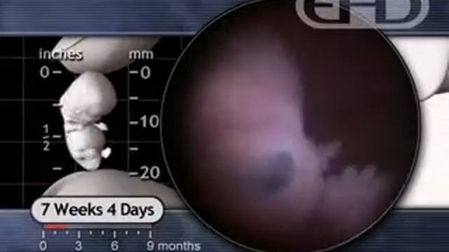 7 Weeks: Hiccups and Startle Response смотреть онлайн