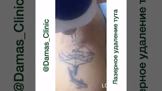 Лазерное удаление татуировки плеча смотреть онлайн