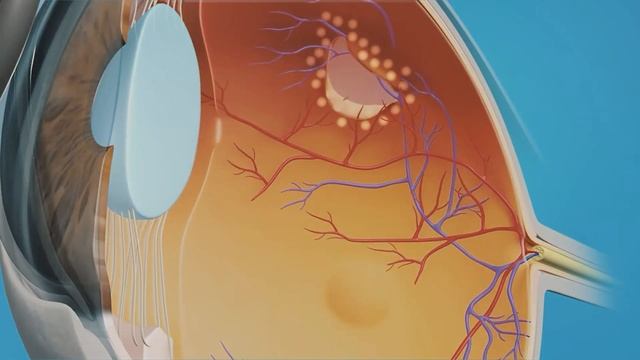 ¿Qué es la Fotocoagulación Láser? смотреть онлайн