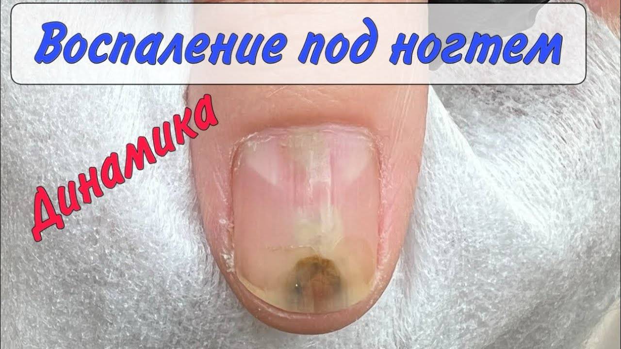 Это сделал гель-лак _ Воспаление под ногтем _ Подногтевой панариций смотреть онлайн