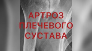 Артроз плечевого сустава