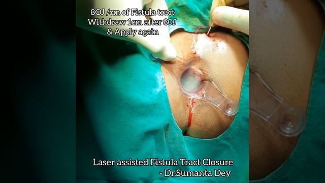 Laser Assisted Fistula Tract Closure By Dr.Sumanta Dey