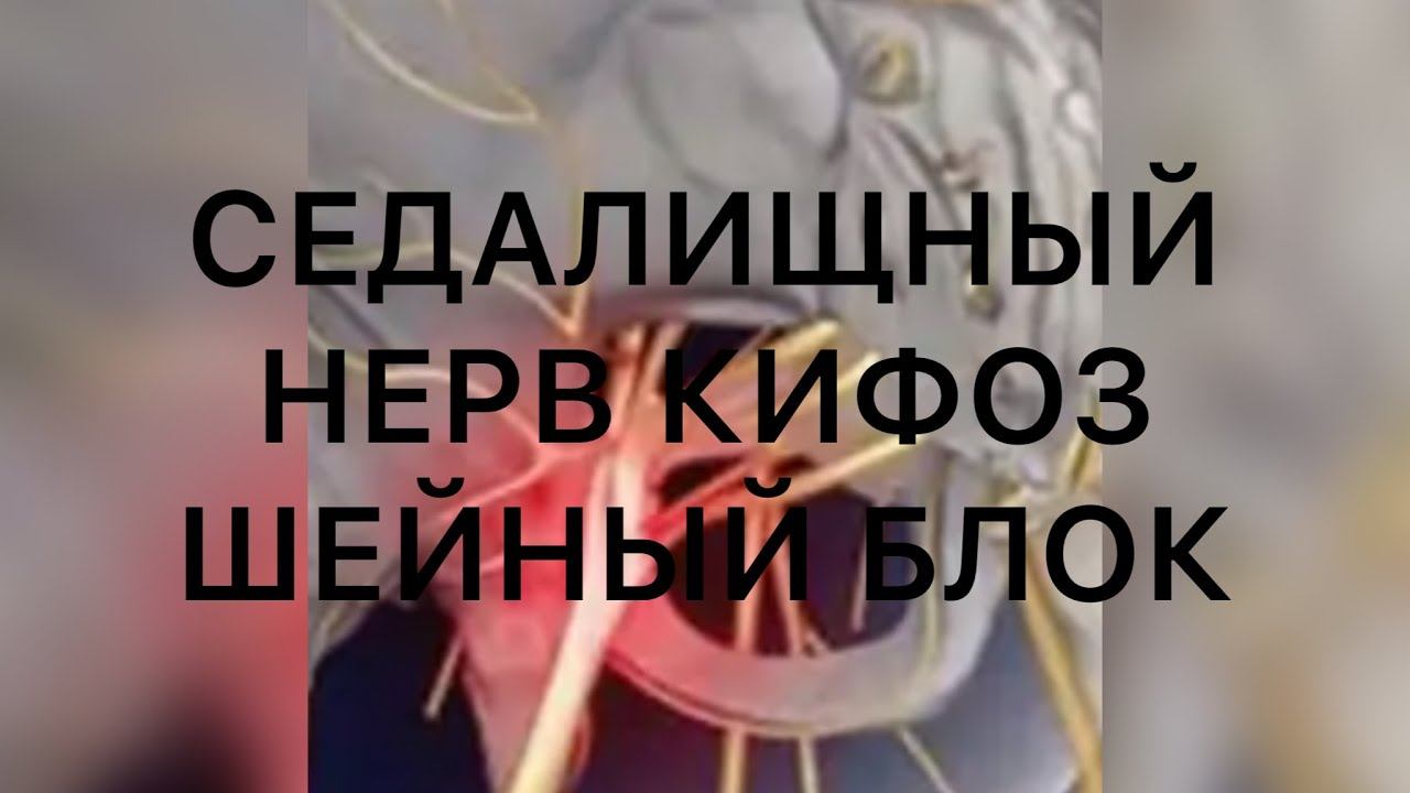 Ущемление седалищного нерва, шейный остеохондроз, кифоз