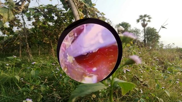 Ear Wax Removal Eps#282 || чистка ушной серы #282