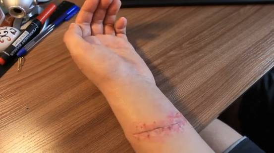 Порез сухожилий предплечья смотреть онлайн