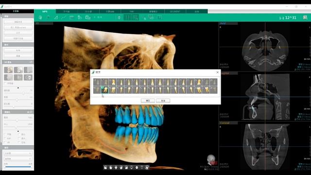 3 Ez3D i SEGMENT介面 MPR介面拔牙模擬 中文介面 字幕V03 смотреть онлайн