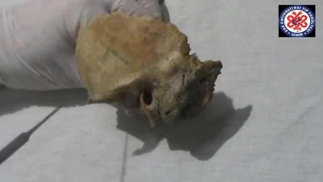 17 Os temporale, os sphenoidale смотреть онлайн