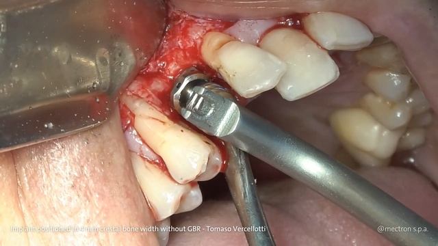 IMPLANTOLOGY - Prof. Tomaso Vercellotti - Implant positioned in 4 mm crestal bone width смотреть онлайн