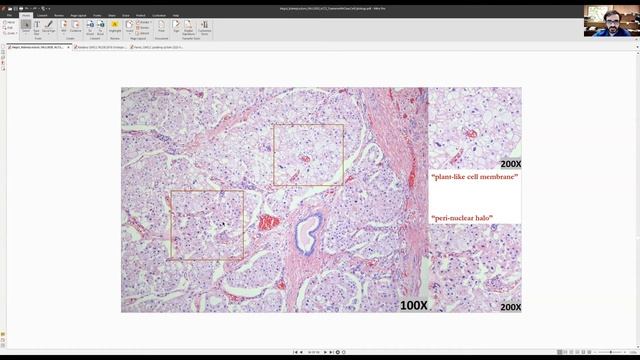 Uropatoloji Turkce #4: Chromophobe Renal Cell Carcinoma. смотреть онлайн