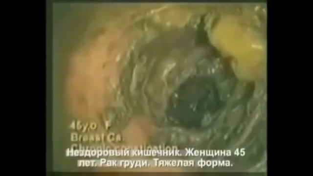 Паразитоз- опасность для здоровья!