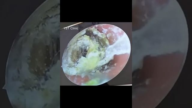 Keratosis Obturans: The Referred Case