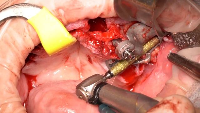Transnasal - Zygomatic - Jdental смотреть онлайн