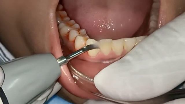 Tartar , Plaque And Calculus Removal - Dental Polishing For 20 Years Old Female