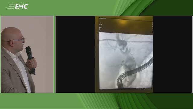 4. Завьялов М.О., Белов А.А., Волков А.А., Тюльбекова А.А., Золотарева Н.А. Сложный холедохолитиаз.