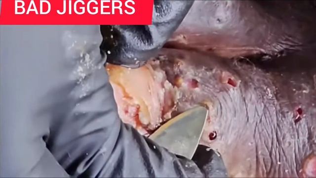 Remove Jiggers from foot 🦶🦶😳🐜Bad Jiggers investation🐜🐜😭 смотреть онлайн