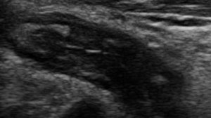 Острый аппендицит (УЗИ). Подборка случаев.