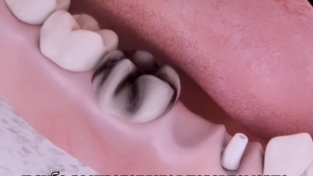 Установка моста на имплант, нюансы #perfectstom #стоматологияалматы #имплантациязубов