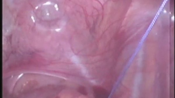 rectal prolpase surgery